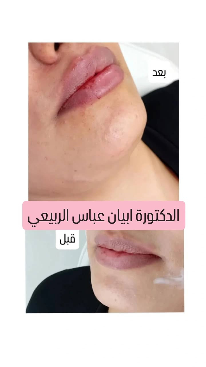 ✨ عروض التجميل غير الجراحي ✨
لفترة محدودة فقط 🤍
💋 فلر شفايف كوري 45 ألف بدل 60 ألف
💋 فلر شفايف إيطالي 60 ألف بدل 80 ألف
✨ فلر تغيير شامل 175 ألف بدل 225 ألف
💉 بوتكس 100 ألف بدل 125 ألف
🌸 إبر نضارة وتبييض 30 ألف
🐟 إبرة السلمون 70 ألف
🧡 إبرة العنبر 50 ألف
🌿 إبرة التصبغات 35 ألف
🧵 تقطيع ألياف 50 ألف
🧵✨ تقطيع ألياف + إبر نضارة 65 ألف
👁️ بوستر العين لتقليل الهالات 75 ألف
📍 العنوان: بغداد – الزعفرانية – شارع المعهد
Dr. Abyan Abass
📲 للحجز والاستفسار (واتساب):
***********
***********
✨ لا تضيعين الفرصة، احجزي موعدج هسه واستفادي من عروضنا المميزة مع الدكتورة  أبيان عباس 💉🤍
