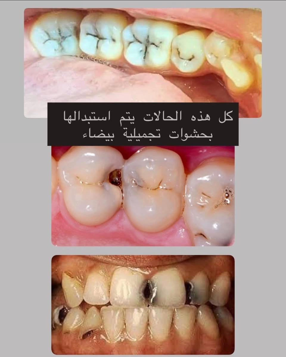 📢اي شخص محتاج
🟢قلع 
🟢حشوات بيضاء ودائمية
🟢تنظيف اسنان
🟢تعويض اسنان باطقم متحركة

وشبه مجاناً✅✅✅

كل هاي الخدمات متوفرة بشكل شبه مجاني داخل كلية طب الاسنان في جامعة الموصل وتحت اشراف افضل الاطباء على مستوى العراق

الاعداد محدودة احجزوا هسة حتى يتثبت مكانكم

للحجز والاستفسار: *********** 
او مراسلة الصفحة
