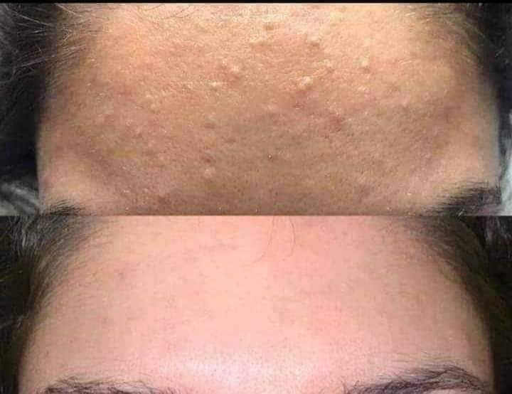 ‎خلطة رجالية /نسائيه

‎لتبيض الوجه 🔴علاج الكلف بالوجه حب الشباب واثاره 🔴التصبغات 
‎و عدم صفاء ونقاوة البشره 
‎الهالات السوداء

‎ خلطه تبيض الوجه وازالة الكلف والنمش المنتج
‎🌹خلطة  السحريه لتبيض الوجه  وبمفعول دائمي 😍
‎كل هذا بسر نجاح خلال اسبوع فقط لاغير لان سر جمالك هو اختصاصنا😍
‎المنتج مضمون ١٠٠٪


**إذا كنت صاحب هذا الإعلان وتريد حذفه لأي سبب، رجاءا أرسل رسالة إلى الدعم الفني**