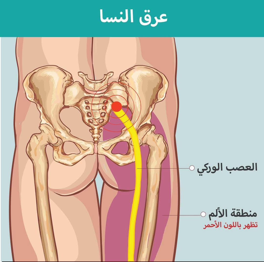 الفرق بين عرق النسا ومتلازمة العضلة الكمثرية 

‏1️⃣ البداية:
‏كلنا نسمع عن “عرق النسا” و”متلازمة العضلة الكمثرية”، لكن كثير ناس يخلطون بينهم! في هذا المنشور راح نوضح الفرق بطريقة بسيطة وسهلة 👇

‏2️⃣ عرق النسا (Sciatica):
‏💡 التعريف: ألم ينتج عن انضغاط أو تهيج العصب الوركي (أطول عصب بالجسم).
‏💥 الأعراض:

‏•ألم يبدأ من أسفل الظهر ويمتد للرجل.
‏•إحساس بوخز أو تنميل.
‏•ضعف عضلي في الرجل أحيانًا.
‏🔍 الأسباب:
‏•انزلاق غضروفي.
‏•تضيق القناة الشوكية.
‏•إصابات العمود الفقري

3️⃣ متلازمة العضلة الكمثرية (Piriformis Syndrome):
‏💡 التعريف: حالة نادرة تكون فيها العضلة الكمثرية (عضلة صغيرة في الحوض) تضغط على العصب الوركي.
‏💥 الأعراض:

‏•ألم في الأرداف يمتد للرجل أحيانًا.
‏•يزداد الألم مع الجلوس الطويل أو النشاط.
‏🔍 الأسباب:
‏•توتر أو تقلص في العضلة الكمثرية.
‏•إصابات الحوض.
‏•إجهاد عضلي متكرر

‏4️⃣ الفرق الجوهري:
‏✨ عرق النسا: مشكلة رئيسية في العصب الوركي نفسه (الضغط عليه عادة من العمود الفقري).
‏✨ متلازمة الكمثرية: العضلة الكمثرية تضغط على العصب الوركي، وهو سبب خارجي للعصب

هناك عرق النسا كاذب وحقيقي ونعرفه عن طريق الاعراض والفحص السريري

5️⃣ التشخيص 🩺:

‏•عرق النسا: MRI أو أشعة للعمود الفقري.
‏•العضلة الكمثرية: تشخيص سريري يعتمد على الأعراض والاختبارات اليدوية

‏6️⃣ العلاج:
‏🛠️ عرق النسا:

‏•أدوية لتخفيف الألم.
‏•تمارين لتحسين قوة ومرونة العمود الفقري.
‏•جراحة في الحالات الشديدة.

‏🛠️ متلازمة الكمثرية:

‏•تمارين إطالة العضلة الكمثرية.
‏•علاج طبيعي ومساج.
‏•أدوية مرخية للعضلات
7️⃣الخاتمة:
‏إذا كنت تعاني من ألم في الأرداف أو الرجل، لا تتجاهل الأعراض . التشخيص السليم هو المفتاح للعلاج الصح. 
ويكون علاج هذه الحالتين عن طريق العلاج الطبيعي والتمارين
العنوان 
o3 fitness للعلاج الطبيعي 
بغداد. المشتل. قرب مستوصف المعلمين النموذجي. بتجاة المدارس او الدفاع المدني 
هناك معالج للرجال 
*********** للحجز والاستفسار
الاخصائية المعالجة الفيزيائية
@إشارة
