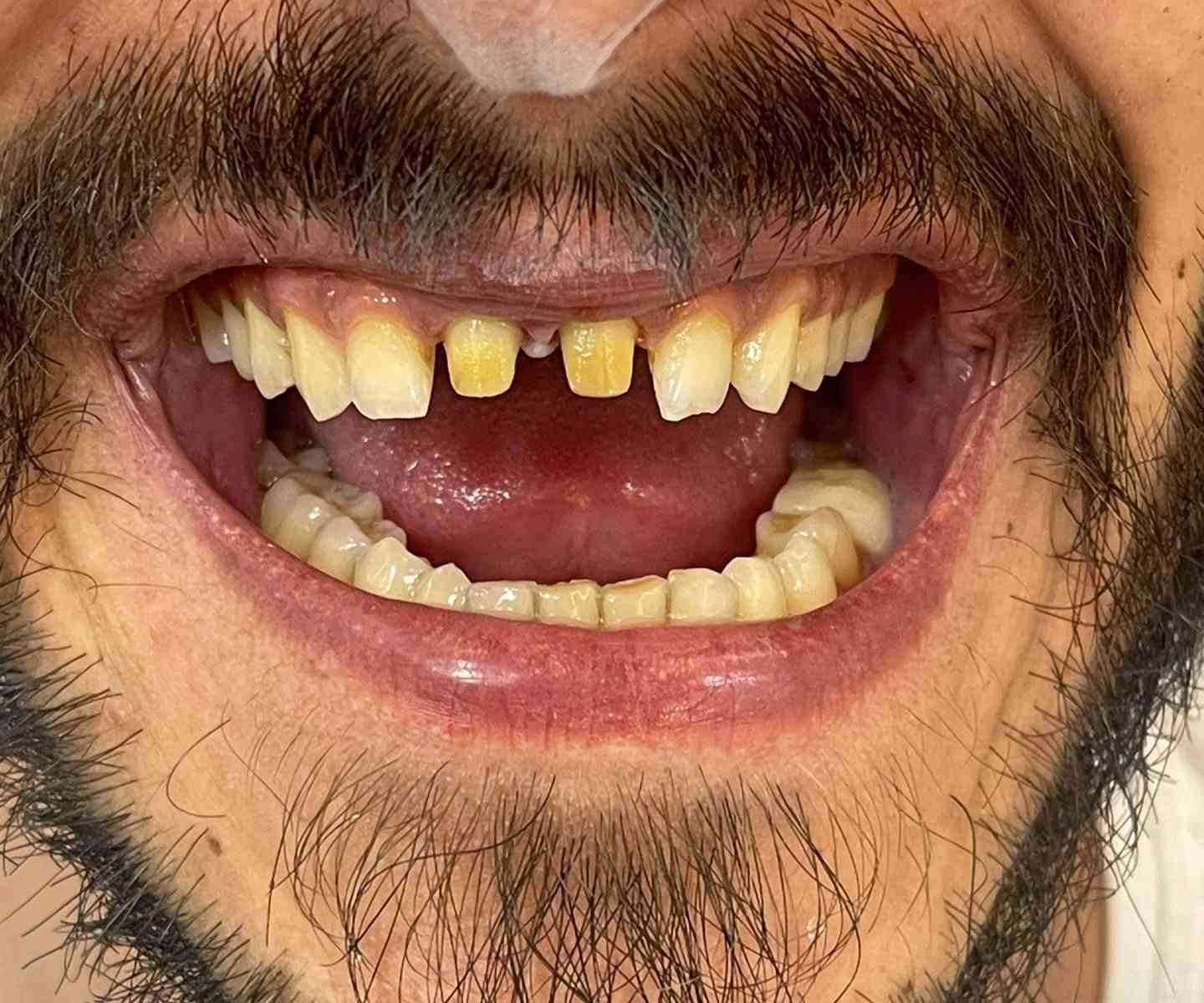 🔥 عرض ابتسامة زاركون لهذا الاسبوع
برد بسيط + شغل مختبر احترافي
لون وشكل حسب اختيارك
نتيجة طبيعية وثابتة

عيادة الدكتورة هند الحسيني 
***********
الامين الثانيه/شارع المهداوي /فوق صيدلية غزوان باسم
