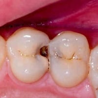 حشوات ضوئية مجانة • كلية المنارة • سن خلفي متسوس