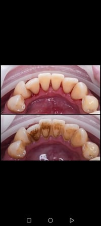 النجف • علاج أسنان مجاني • طقم جزئي