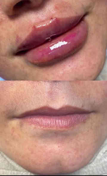 ارقى العروض من مركز لمسات  🫰❤️
عرض لمده اسبووووووعً🌺

هذا البيج مركز لمسات 

عرض التغيير الشامل ب٢٠٠ الفلر كوري  مع ابرة نضاره هديه♥️🥰

ب٢٥٠ مع البوتوكس الف بالفلر الفرنسي مع البوتوكس عرض ميتعوض فقط لحد  راس السنه♥️

فلر كوري السيسي ب٢٥ الف  للوجنات للشفه ب٣٠ 🌺

فلر امريكي ب٤٠ الف السيسي للوجنات للشفه ب٥٠  الف السيسي 🌺

فلر فرنسي ب٥٠ الف السيسي 
للوجنات و٦٠ الف للشفه 🥰😍
تغيير شامل يشمل البوتوكس بالفلر الكوري٢٠٠ الف يشمل بوتوكس وبدون بوتوكس ب١٥٠ الف مع جلسه نضاره وتنظيف وره اسبوع مجاني ♥️💐😍
عروض البوتوكس 
وجه كامل ٥٥ ♥️🥰

عين وجيبن ب٤٠ الف كل ثنين ب٧٥ عيون وجبين وجه كامل ١٠٠ للصديقات سوا ♥️

عرووض اليزر فل بدي ب٧٥ الف مع الظهر والبطن 💖
بكيني واندرام ثنينهن ب٢٥ 🌺

ساق كامله ب١٥ ايد كامله ب١٥ 😊
وجه ب١٠ رقبه ب١٠ 👌
مسح الاوشام  والتاتو الجلسه ب١٠ 🌺

ليزر كاربوني الجلسه ب١٠ 🌺

عروض البلازمه المفعله بالعمبر ب٢٥ الف الجلسه 💖💐
فقط بلازمه مفعله ب١٠ الجلسه 😊♥️

عرووض الميزوات جميع انواع الميزوات وابر النضاره الجلسه ب٢٥ 😍🌺

جميع العرووض تشمل تنظيف بشره ♥️🌺♥️💖مجاني مع كل جلسه وتدددلون علينه 🥰

للاستفسار الاتصال واتساب ***********
