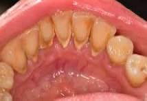 السلام عليكم منو يحتاج تنظيف اسنان وازاله جميع التكلسات مثل الي بل صور الي محتاج يتواصل وياي على الرقم *********** 
العنوان:كلية طب الأسنان جامعه بابل مقابيل كراج الموحد 
الوقت :ساعه العاشره صباحا علما ان العلاج بشكل مجاني
