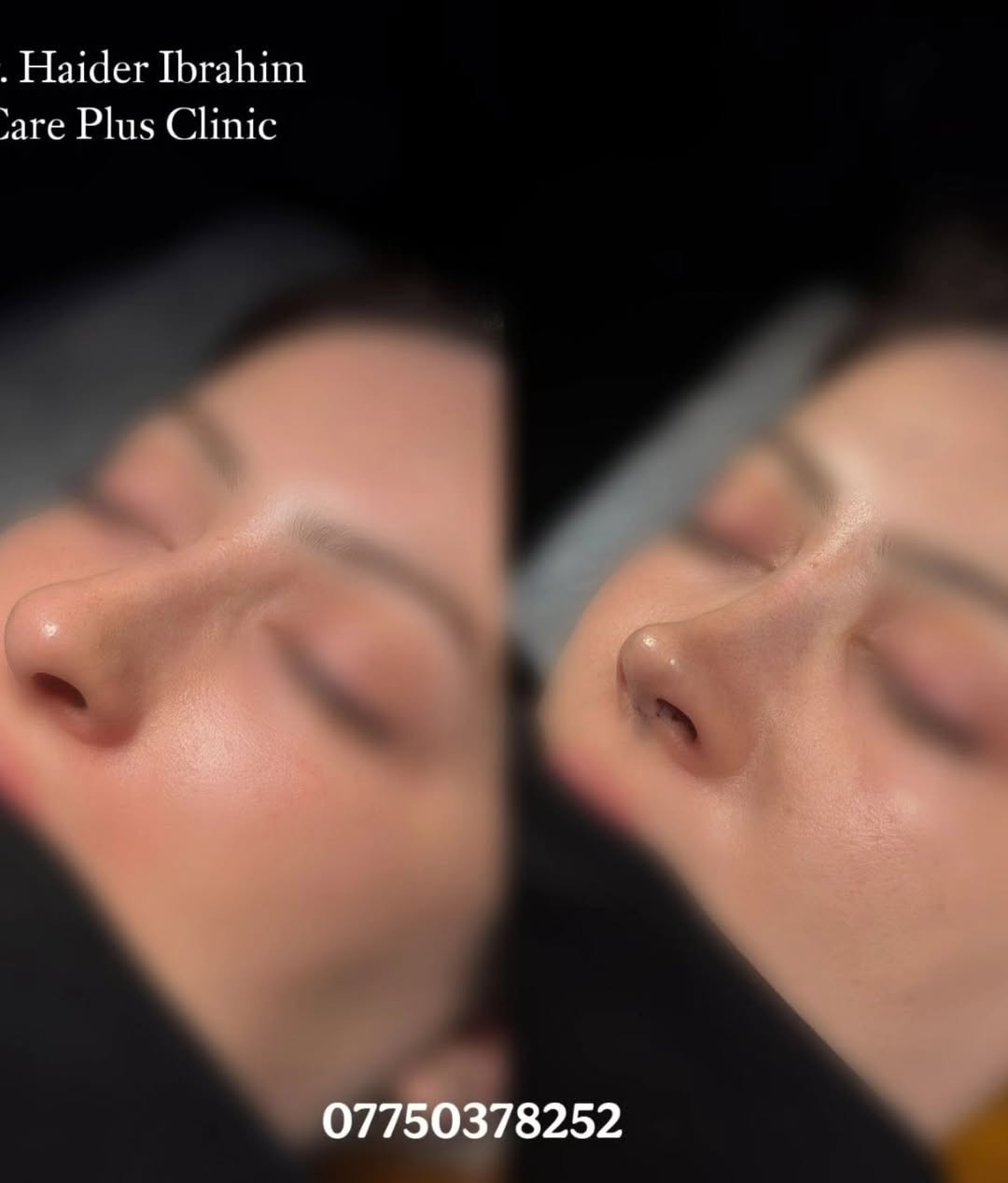 ✨ تجميل أنف أنثوي برسمة متناسقة تناسب ملامح الوجه ✨

نتائج طبيعية ولمسة جمالية تحافظ على تناسق الوجه، مع تصميم يناسب ملامح كل حالة بشكل فردي للحصول على مظهر أنثوي ناعم وجذاب.

👨‍⚕️ الدكتور حيدر إبراهيم 📍 متواجد يوميًا لاستقبال المعاينات والحجوزات. 📞 ***********

#تجميل_الأنف #رأب_الأنف #أنف_أنثوي #تجميل #نتائج_طبيعية جراحة_تجميل الدكتور_حيدر_إبراهيم بغداد العراق
