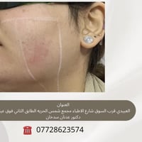 ليزر الوجه • جهاز كانديلا • العبيدي