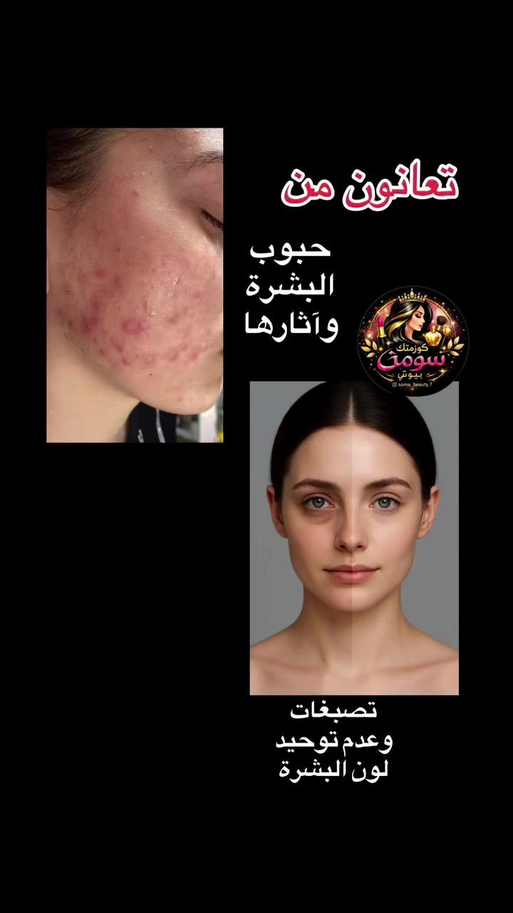 التركيبه الخاصه من كوزمتك سومه بيوتي🎀
تخلصكم من 
حبوب البشرة و آثارها
تصبغات البشرة و عدم توحيد اللون
تجاعيد
📞 ***********
📸 Instagram: soma_beauty.7
📩 Telegram: soma_beauty.7
🎵 TikTok: soma_beauty.7
Facebook: كوزمتك سومه بيوتي
#كوزمتك #fyp #اكسبلور_فولو #كوزمتك_سومه_بيوتي #كركوك
