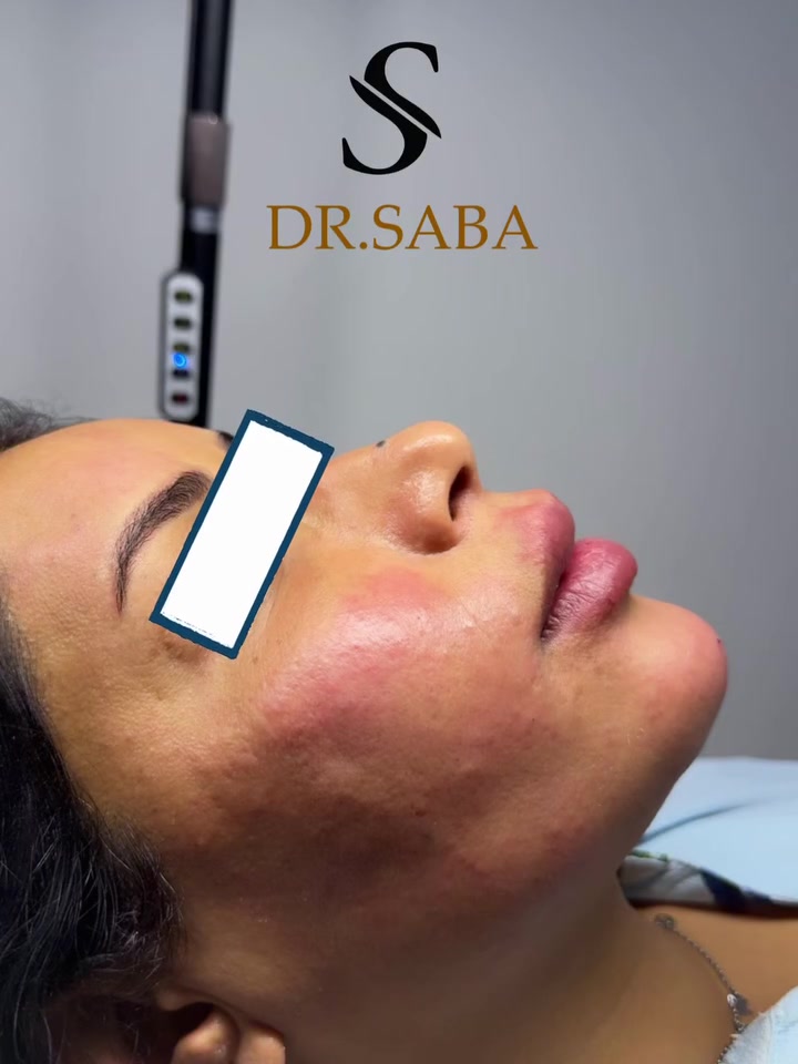 تكنيك الوجه كامل بأيدي للجميلة روح ع اخر صورة وشوفو القبل♥️🫶🏻

فلر شفة + ذقن + استدارة بسيطة
#فلر #فلرشفة_فلر_وجنات_فلرخطوط_ضاحكة_فلرذقن_تكساس_تكنيك❤️❤️❤️ #فلر_بوتكس #فلر_شفايف👄


**إذا كنت صاحب هذا الإعلان وتريد حذفه لأي سبب، رجاءا أرسل رسالة إلى الدعم الفني**