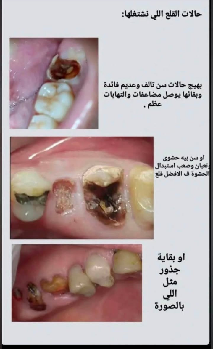 تستقبل عيادات طب الأسنان – جامعة المعارف
📍 شارع 100

✅ حالات قلع الأسنان
✅ بقايا الجذور التالفة
✅ حشوات الأسنان التجميلية (البيضاء)

جميع العلاجات تتم بإشراف أطباء اختصاص داخل العيادات التعليمية.

📩 للحجز أو الاستفسار، راسلني خاص

*********** واتساب .
