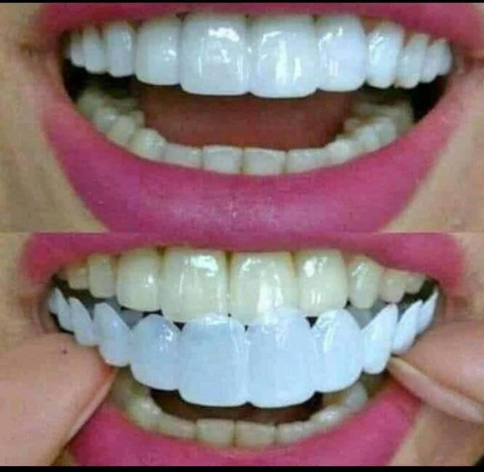 طقم اسنان  snapon smile

snapon smile شلون تتركب كم مده
تبقى.......الخ

شوفو حبايبي 💋بالبدايه تنضفون اسنانكم واول شي تخلون السيلكون بماء حار
((تجي وي كل فك سلكونه عباره عن ماده جيلاتينيه صلبه)) ‼️
وتخلو ع الاسنان بعده تلبسون الفك راح يتخذ الحجم المناسب للاسنان استخدامه كوولشي سهل طبعا يستخدم للمناسبات او الايام العاديه كولش مناسب وسهل وينطي مضهر حلو

🦷عادي تفرشو بمعجون وفرشه 😅
🦷عادي تاكلون بي وابد ميتلون  سواء شربتو شاي او قهوه ....
🦷عادي تنامون بي ...
🦷عادي تلبسو 24 ساعه ..
🦷عادي تشيلو وترجعون تلبسو مره ثانيه.
🦷كوولش طبيعي ....
🦷مناسب لكافه الاعمار ...
🦷مصنوع من ماده السيليكون القوووي
يبقى طول العمر طبعا بعد متشيلي تحفظي بالعلبه الخاص بي.


**إذا كنت صاحب هذا الإعلان وتريد حذفه لأي سبب، رجاءا أرسل رسالة إلى الدعم الفني**