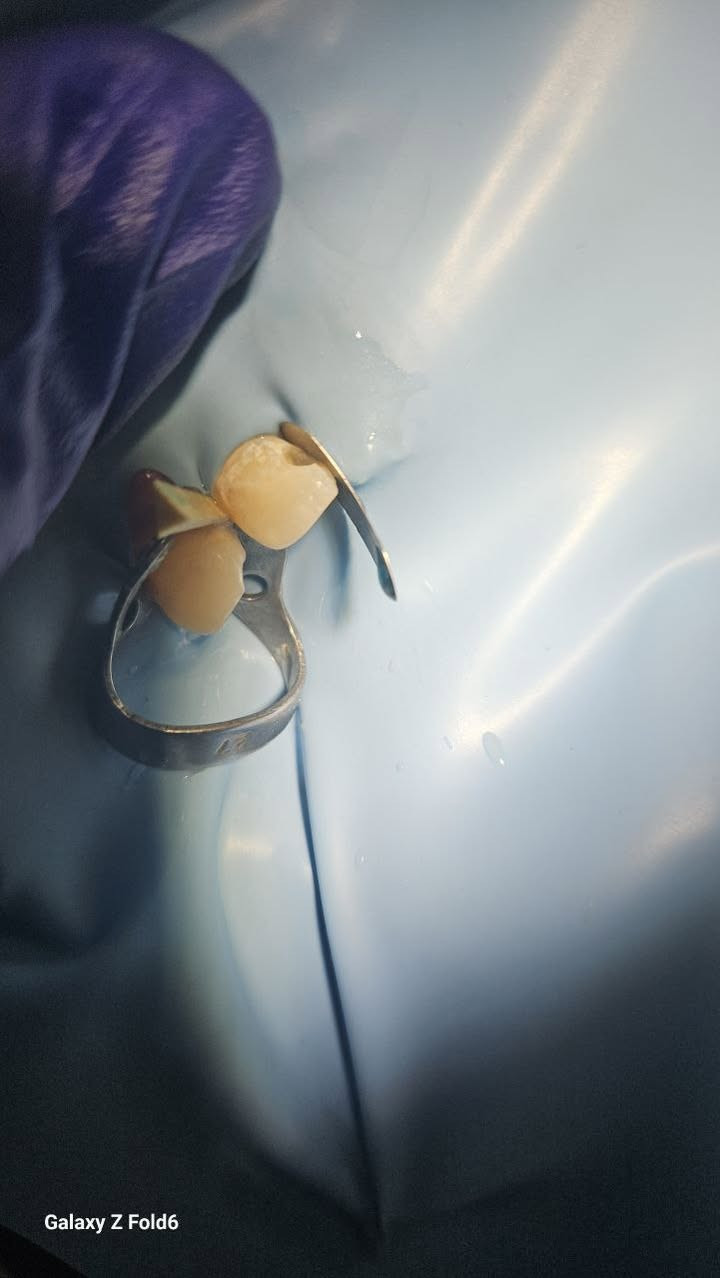 السلام عليكم

يتوفر

- قلع الأسنان والجذور

- تنظيف و تبييض الأسنان وازالة التكلسات

- تركيب تخم اسنان كامل

- حشوات و حشوات (الجذور)

-معالجة اسنان الاطفال مع جلسات الفلورايد

حشوات اسنان و قلع اسنان الاطفال

-تقويم الاسنان

جميع الخدمات (مجانا)

العنوان تقاطع القدس

التواصل خاص

او واتساب على الرقم

***********
