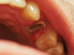 السلام عليكم
الي عنده بقايا جذور تالفه ( جعب )
او محتاج قلع سن خل يراسلني علماً ان العلاج مجاني وتحت اشراف اطباء اختصاص
ومع تعويض الاسنان المفقوده


**إذا كنت صاحب هذا الإعلان وتريد حذفه لأي سبب، رجاءا أرسل رسالة إلى الدعم الفني**