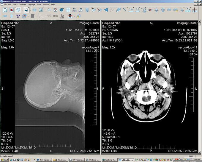 هل تعمل في مجال الأشعة الطبية؟
هل تبحث عن برنامج موثوق وسهل الاستخدام لعرض وتحليل صور DICOM؟

نقدّم لكم برنامج Efilm Workstation 4.2.– الحل المثالي لأخصائيي الأشعة والمفراس والرنين السونار والمراكز الطبية!

مميزات البرنامج:

عرض صور DICOM بجودة عالية

أدوات متقدمة للتحليل والتكبير والقياس

يعمل ك workstation او pacs
وتعديل الألوان والكونتراست

دعم الصور ثلاثية الأبعاد 3d

سهل الاستخدام وسريع الأداء

يعمل على مختلف أنظمة Windows

امكانية الطباعه على جميع انواع طابعات الاشعه والطابعات الورقيه العادي

#ضمان لمدة سنتين حقيقي وفعلي 

السعر مميز جداً لفترة محدودة!
اطلب نسختك الآن وابدأ بالعمل بكفاءة واحترافية.

للطلب أو الاستفسار:
راسلنا عبر الرسائل أو اتصل بنا واتساب : [*********** ]
الخاص مفتوح 

#برنامج_الأشعة #DICOM #Efilm_Workstation #برنامج_طبي #مركز_أشعة #عرض_صور_طبية
