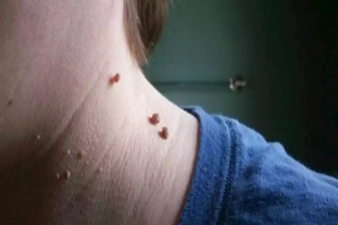 تخلص من الزوائد اللحميه بسهوله 
توفر عدنه جهاز بلازماج لأزالة الزوائد اللحميه 
حياكم الله
العنوان طريق ناحية صباغية مقابل جامع سويف مجمع البتول الطبي
للاستفسار ***********
واتساب +اتصال
