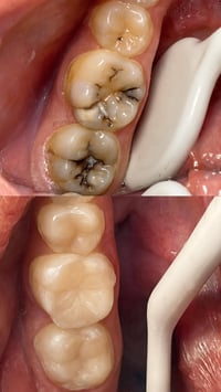 معالجة تسوس الأسنان بالحشوات التجميلية ✨ نرجعه مثل الأول بحشوات كنز ال...