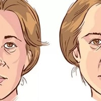 شلل العصب السابع • علاج طبيعي فيزيائي • الطارمية شارع الكيلاني