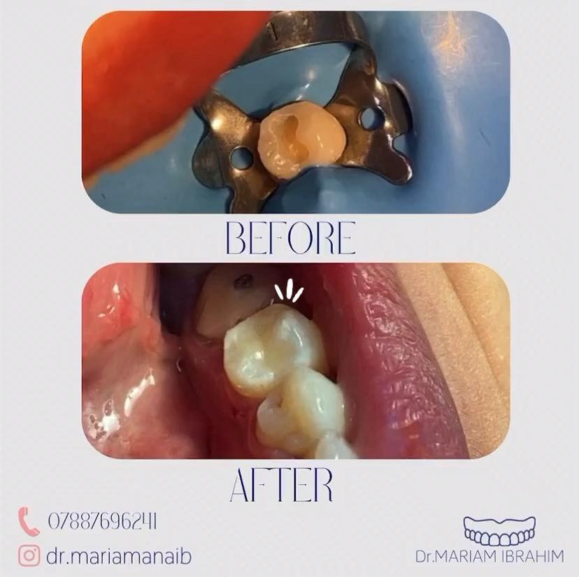 السلا عليكم …
الي محتاج قلع للأسنان التالفه و الجذور و الي محتاج حشوات ضوئيه و الي محتاج طقم جزئي متحرك و الي محتاج تنظيف اسنان من التكلسات و التصبغات خلي يتواصل ويايه *********** او عن طريق حسابي على الانستكرام dr.mariamanaib  … الموقع بغداد /حي الحسين / قرب بانزين خانة حي العامل …… علماً ان العلاج مجاناً و تحت إشراف اطباء مختصين 🤍
