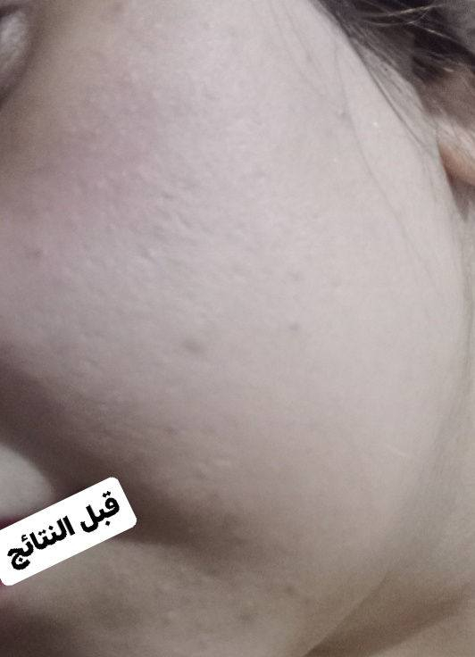 اكووووووووو هجي جمااااال اكوووو هجي تصفيه البشره ونظاره وطبعا بعده العلاج مامخلص بس ملتزمه بي الزبونه 

هذا شغل 
كريم ليلي 
وابرة العنبرررررر 
وشغل ماسك التمن 
وغسول البشره شلووووووووووونهه 😁😁😁😁خليت حتى المسامات تقل وتتقلص 

اجاكم العيددددددددد تعاي دللي نفسج يم دلووووووووش واليوم اجمل عررروض الكم


**إذا كنت صاحب هذا الإعلان وتريد حذفه لأي سبب، رجاءا أرسل رسالة إلى الدعم الفني**