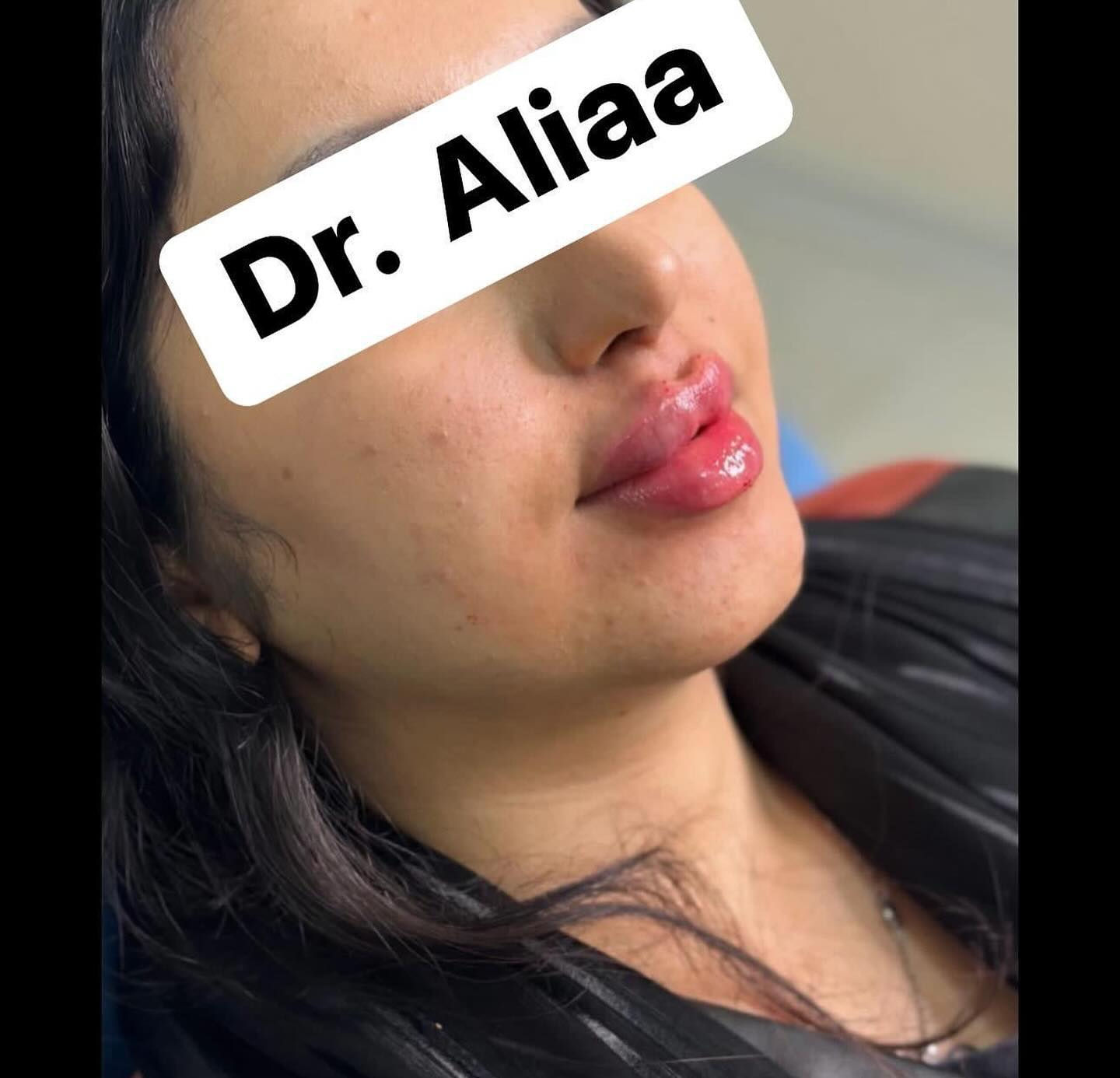 العروض الاقوى في بغداد لجميلات عيادتنة
فيلر الشفاه الكوري💋 50الف فقط  
💉 فيلر تكساس (10 إبر) فقط250 ألف😍  
 إبرة العنبر 10cc* فقط 150 ألف  
👰 إبرة العروسة فقط 50 ألف ❤ 
ابرة الريفتال ب75الف 
⚡ شد الجبين بالبوتوكس فقط 120ألف  
✨شد الوجه بالخيوط غير الجراحية – 8 خيوط
 فقط 300 ألف
فلر بدي ال60سيسي فقط ب500الف 
جلسة معالج الكميائي فقط 75الف 
 

🌸 عرض الصديقات! 😍 
كل 2 صديقات ياخذن فيلر شفة،  
الصديقة الثالثة فيلر شفة + تنظيف بشرة مجاناً!

💆‍♀️تنظيف البشرة العميق الملكي فقط 30 ألف  
🌟 جلسة إزالة الكلف والتصبغات فقط 50 ألف  
(مع جلسة نظارة مجانية)  
👃جلسة تذويب دهون الأنف بدون جراحة فقط 50 ألف
عرض اليزر بجهاز الكاندلا البارد المنطقة فقط15الف 
الفول بدي فقط ب65الف
📍 *الموقع:* بغداد – حي الاعلام  
📞 *للاستفسار:* ***********  
احجزي الآن قبل نفاد المواعيد!

--- ⁩
