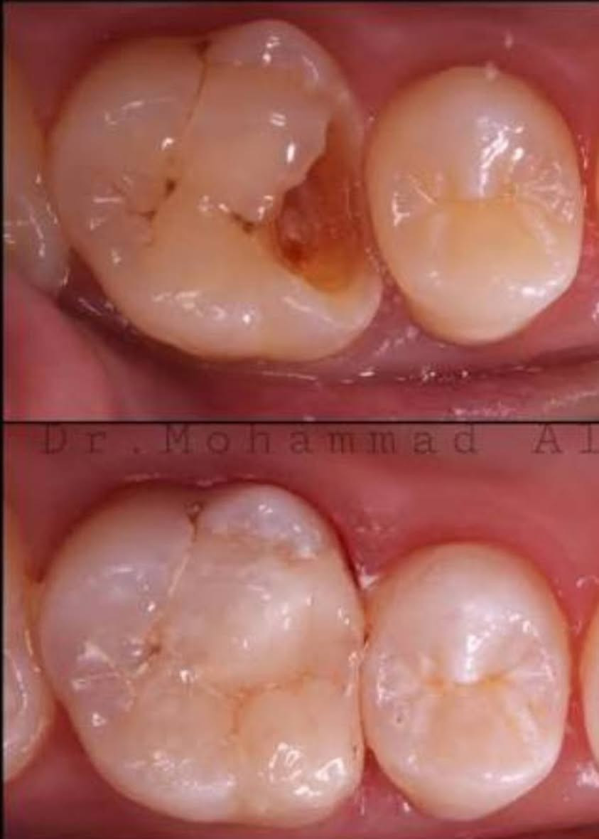 تعلن جامعة الكفيل عن تقديم خدماتها في مجال طب الاسنان
🔴مجانا 🔴مجانا 🔴مجانا
🔴قلع الاسنان التالفة والجذور المتبقية
🔴طقم اسنان جزئي متحرك
🔴حشوات ضوئية
🔴تنظيف الاسنان
التواصل على الواتساب***********
العلاج مجانا تحت إشراف أطباء اختصاص
📍عيادات جامعة الكفيل /شارع الإسكان/ قرب مستشفى الزهراء
