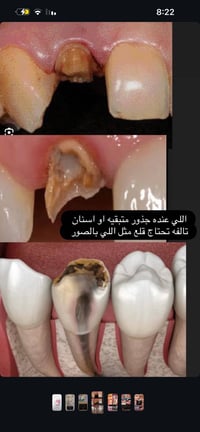 قلع مجاني • البصرة