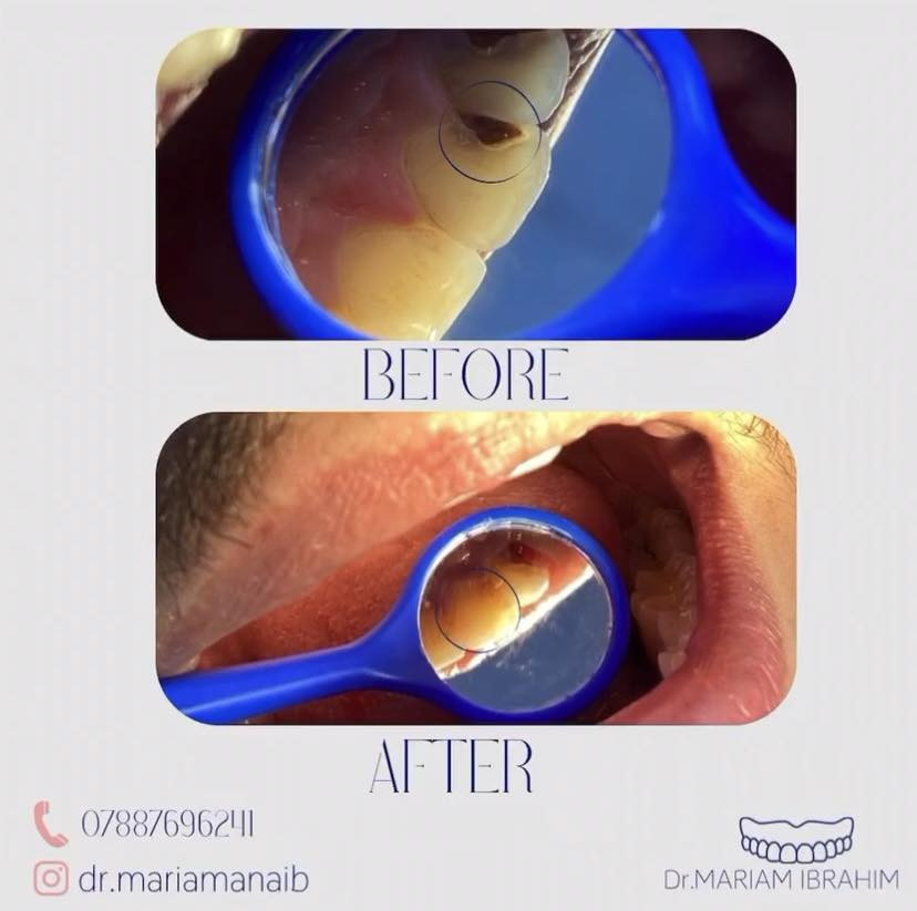 السلا عليكم …
الي محتاج قلع للأسنان التالفه و الجذور و الي محتاج حشوات ضوئيه و الي محتاج طقم جزئي متحرك و الي محتاج تنظيف اسنان من التكلسات و التصبغات خلي يتواصل ويايه *********** او عن طريق حسابي على الانستكرام dr.mariamanaib  … الموقع بغداد /حي الحسين / قرب بانزين خانة حي العامل …… علماً ان العلاج مجاناً و تحت إشراف اطباء مختصين 🤍
