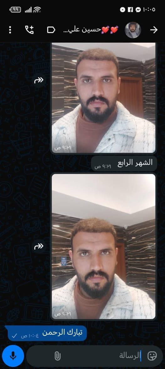 💰 السعر يبدأ من 650 - 850 الف حسب مساحة الصلع 
🔴 العملية تُجرى على يد كادر طبي مختص (وليس خبير)

حفاظاً على صحتكم نستخدم احدث التقنيات 
❇️ الزرع بتقنية حجر الزفير (حصريًا)
❇️ و القطف بتقنية الاقتطاف FUE الأحدث عالميًا

🔹 زراعة 6D و3D
🔹 للرجال والنساء
🔹 تشمل:
 • زراعة شعر الرأس
 • اللحية،شارب 
 • الحواجب
 • الحروق والندوب

⚡️ مدة العملية: لا تتجاوز 8 ساعات
⚡️ عدد البصيلات مفتوح دون الضرر بالمانحة 
⚡️ التخدير: موضعي وبدون ألم ✔️

⸻

🎁 يشمل العرض مجانًا:

✅ المعاينة والفحوصات قبل العملية 🔬🧪
✅ 8 جلسات بلازما (منشأ إيطالي) 💉
✅ 8 جلسات ميزوثيرابي (إسباني – فيتامينات، أحماض، معادن) 💉
✅ غسل الشعر يوميًا بعد الزراعة
✅ حقيبة علاجية متكاملة بعد العملية 💊
✅ وجبة طعام للمريض 🍔
✅ شهادة ضمان مدى الحياة
✅ شامبو طبي
✅جلستين نضارة للبشرة
⸻

مرحباً استاذ 💟
للاستفسار مع مختصين زراعة الشعر في مركزنا عبر واتس اب يرجى الضغط هنا 👈🏻 https://wa.me/9647772044099


**إذا كنت صاحب هذا الإعلان وتريد حذفه لأي سبب، رجاءا أرسل رسالة إلى الدعم الفني**