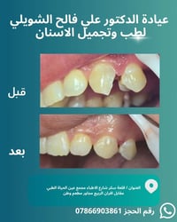 حشوات ضوئية • تجميل أسنان • قلعة سكر