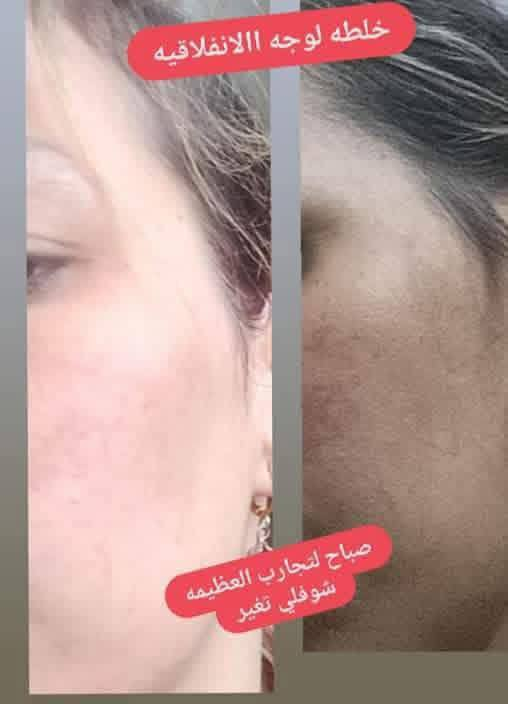 نبيع كيمر مو خلطه امانه الله تسوي وجهج كيمرررر
خلطه تسوي وجهج كيمر  امانه الله مبيها عصارات
خلطتني اغلبيه بنات مجربتها ويعرفون شغلها يموت كلف نمش تصغبات حبوب اثار حبوب جميع مشاكل بشره بضمان سعره ١٠ فقط


**إذا كنت صاحب هذا الإعلان وتريد حذفه لأي سبب، رجاءا أرسل رسالة إلى الدعم الفني**