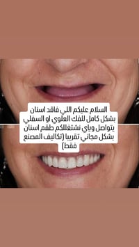 طقم اسنان • مجاني تقريباً • عيادات جامعة الحلة