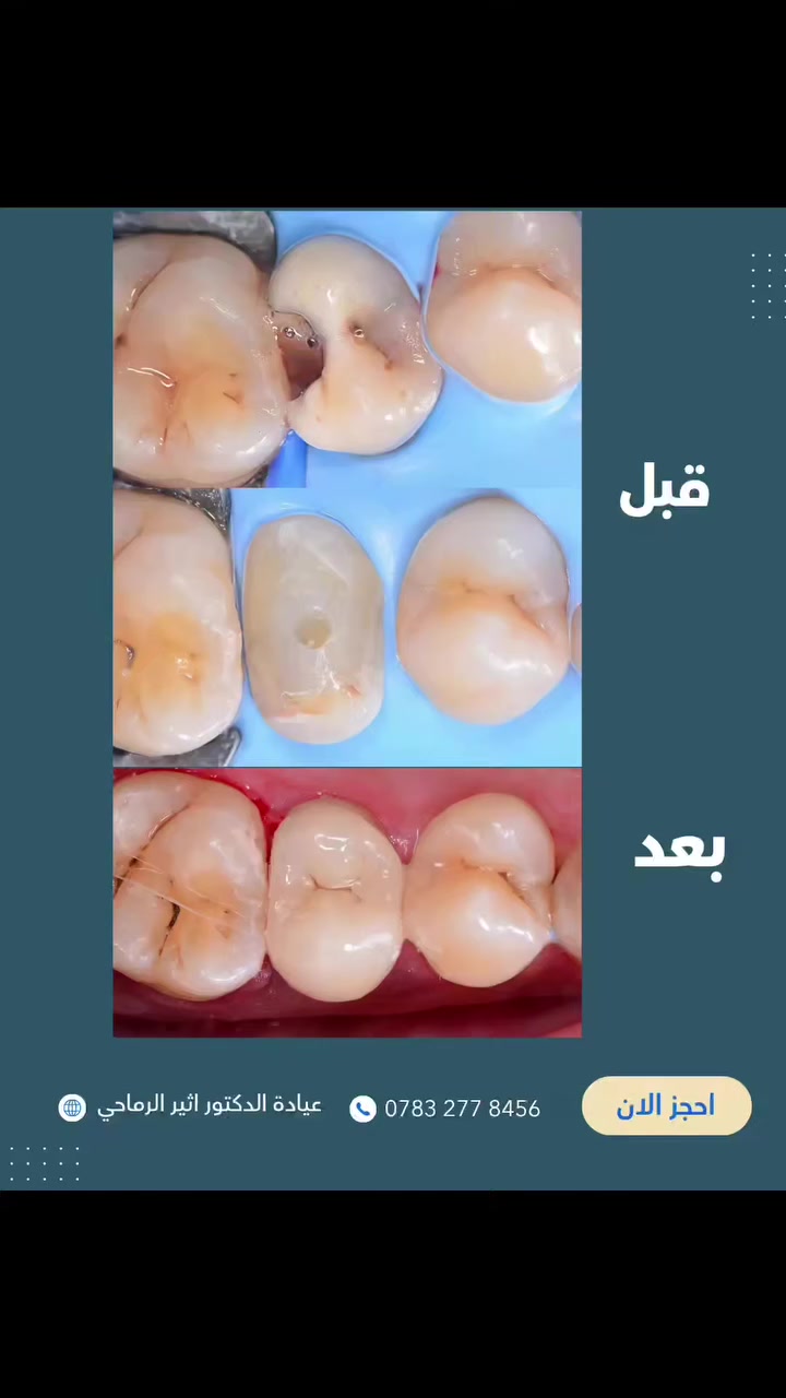 "حشوة تجميلية للأسنان الخلفية 🦷✨

تم إزالة التسوس بدقة وإعادة بناء السن بحشوة تجميلية تحافظ على الشكل الطبيعي والقوة الوظيفية
✅النتيجة: سن نظيف، متماسك، ومظهر طبيعي بدون أي فرق عن الأسنان الأصلية."

     (عيادة الدكتور اثير حليم الرماحي)

☎️للحجز والاستفسار ***********
او مراسلة الصفحة

📍الموقع :
الديوانية- قضاء عفك/شارع الأطباء قرب صيدلية أكرم البديري بناية الدكتورة مروة حمود التميمي الطابق الثاني

#الدکتور_اثير_الرماحي #طب_أسنان #حشوات_تجمیلیه_حشوات_قلع_جراحي #قضاء_عفك
