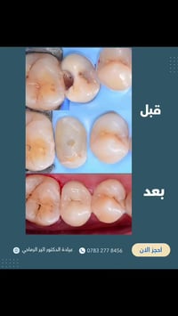 حشوة تجميلية • حشوة خلفية • الديوانية