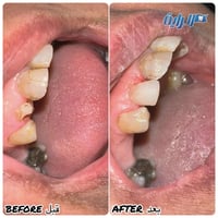حشوة ضوئية تجميلية ضمن كادر عيادة الراية بيد طبيب الأسنان دكتور احمد ع...