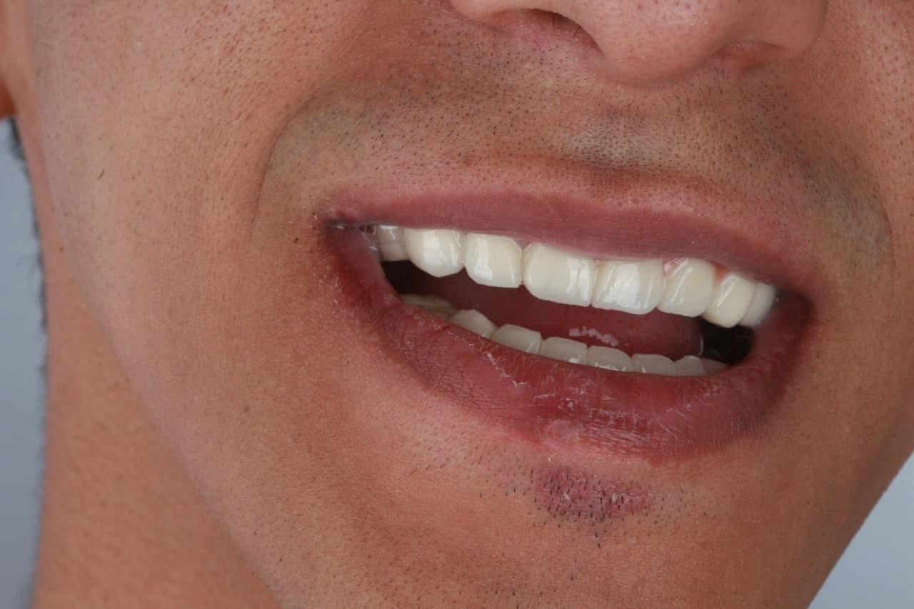 ✨ ابتسامتك تستاهل الأفضل
نرجع لك ابتسامتك بثقة من خلال:
🦷 زراعة الأسنان الفورية
🦷 تركيبات تجميلية طبيعية
🦷 حشوات ضوئية بأحدث التقنيات
✔ نتائج طبيعية وراحة عالية
✔ مواد من شركات عالمية موثوقة
✔ عناية خاصة بكل حالة
📍 حي الحضارة – مقابل فلكة النسر
📞 احجز الآن: ***********
📩 أو راسلنا على الصفحة
ابتسامتك تبدأ من هنا 😁🦷
