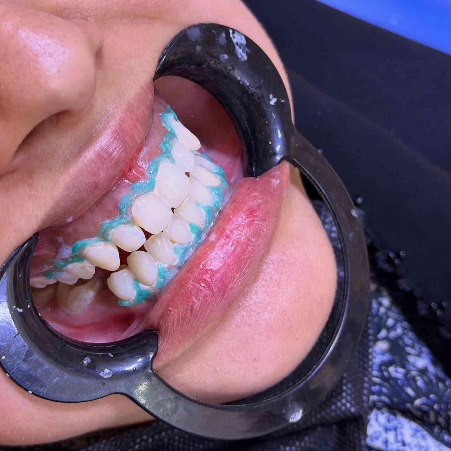 ⁨ شوفو جلسة التبييض 🦷😍 الدكتورة بتول عمار المرمضي 
📍📍عيادة بيرلي (نبتون)
الحمزة الشرقي جهة شارع الملاحة مقابيل صيدلية نجلاء الشيباني 
واتساب او الاستفسار ***********
#الحمزة_الشرقي #الديوانية #الحمزه_الشرقي #عيادة_بيرلي_نبتون #فلر_شفايف #فلرشفة_فلر_وجنات_فلرخطوط_ضاحكة_فلرذقن_تكساس_تكنيك❤️❤️❤️⁩⁩
