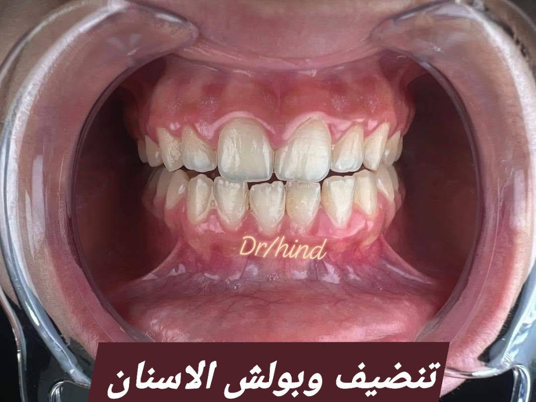 ✨ عروض العيد لتعديل الابتسامة ✨
عيادة دكتوره الدكتورة هند الحسيني 
خلي ابتسامتكم أحلى بهالعيد 😍🦷
🎀 تبييض الأسنان بالليزر
🎀 سد الفراغات بالحشوات التجميلية
🎀 تنظيف وتلميع الأسنان
🎀 ابتسامة دايركت فينير بدون برد
ابتسامة مرتبة وطبيعية من أول جلسة ✨
📩 للحجز والاستفسار مراسلة خاص
او على الرقم ***********
📍الحجز مسبق والأماكن محدودة
@إشارة
