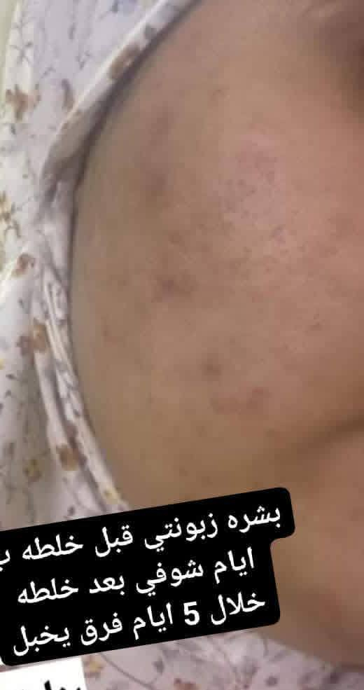 تريدين  بشررتج تصير تضوووي كيمرر جربي خلطه  الكلف وتصفيه خلطه امي عافيتي 💙🔥🔥🔥وشوفي النتائج بعينج تسووي وجهج كيمرر بيااض ثللج نضاره  لمعه تزيل الكلف ونمش وتصبغات توحد لون البشرة تنسين شي اسمه مكياااج  بشرتج تتفلتر


**إذا كنت صاحب هذا الإعلان وتريد حذفه لأي سبب، رجاءا أرسل رسالة إلى الدعم الفني**