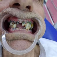 عيادة د زهراء • زراعة أسنان • حلول لمرضى السكر