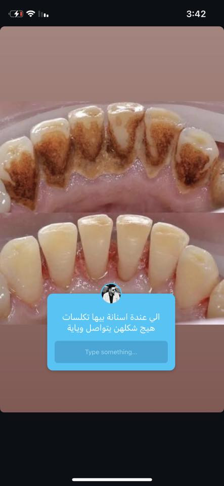 السلام عليكم  متوفر لدينا علاج مجاني بالكامل للحالات المذكورة 👇
1- حشوات تجميليه ( بيضاء) .🦷
2-قلع بقايا جذور الاسنان .🦷
3- تنظيف الاسنان وازالة التكلسات .🦷🪥
4- تعويض الاسنان المفقودة بطقم (تخم) متحرك .🦷

☎️للحجر او الاستفسار مراسلة الصفحة على
الماسنجر او واتساب 📞***********
