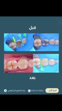 حشوة جذر • حشوة تجميلية ضوئية • قضاء عفك