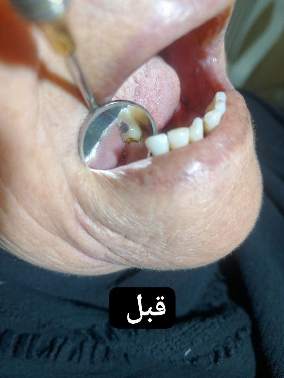 بسم الله الرحمن الرحيم
على بركة الله تعلن عيادة الدكتور علي عبدالرحمن نعمة عن إستقبال الحالات التالية

1_حشوات دائمية ضوئية ومعدنية. 
2_ قلع الأسنان التالفة والجذور المتبقية. 
3_تنظيف الأسنان وإزالة التكلسات. 
4_تعويض الأسنان المفقودة بطقم متحرك.
5_ علاج اسنان الاطفال. 
6_ تعويض الاسنان المفقوده ب طقم كامل للشخص الفاقد أسنانه بالكامل .
7_ حشوات الجذور. 

للحجز والاستفسار تواصل دايركت او واتساب:-
   ‏ *********** ‏       

العنوان : حلة ـ خط النفط - شارع الوردية خارج - مقابل الاستدارة الثانية - قرب صيدلية الكوثر الصافي.
