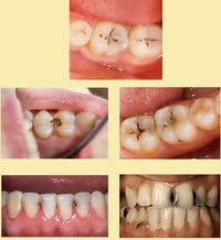 الحلة شارع أربعين • حشوة اسنان • علاج مجاني