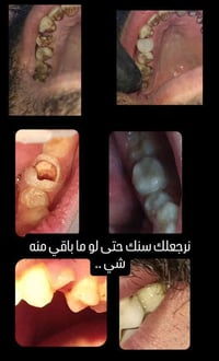 عيادة الروان • ١٧ تموز • زراعة اسنان