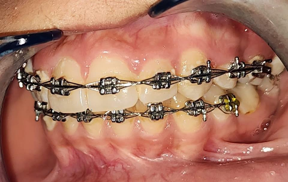 رفع التقويم بعد ترتيب وتعديل الاسنان للفكين
طبيب الاسنان الاختصاص د.عمار عباس
ماجستير تقويم وتجميل الاسنان M.S.c ortho
بكلوريوس طب وجراحة الفم والأسنان B.D.S
بغداد الشعب شارع عدن قرب  مركز شرطة الشعب  مدخل سوق شلال عمارة باريس الطابق الاول دوام العيادة جميع ايام الاسبوع ما عدا الجمعة عطلة من ٤ ل ٨  بدون حجز مسبق الدخول حسب اسبقية الحضور للعيادة الفحص والمعاينة مجاني للاستفسار ***********
