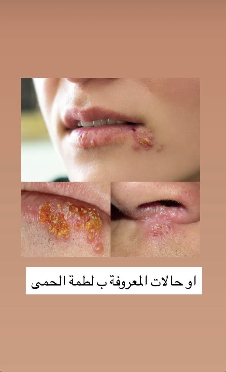 عندك هيج حالات او تعرف احد عنده هيج حالات عالجها و باسرع وقت
يكون العلاج تحت ايادي دكاتره اختصاص في كليه طب الاسنان 

لاحجز او الاستفسار عن اي حاله مراسله الرقم التالي: ***********

يكون العلاج في الزبير في عيادات كليه طب الاسنان
