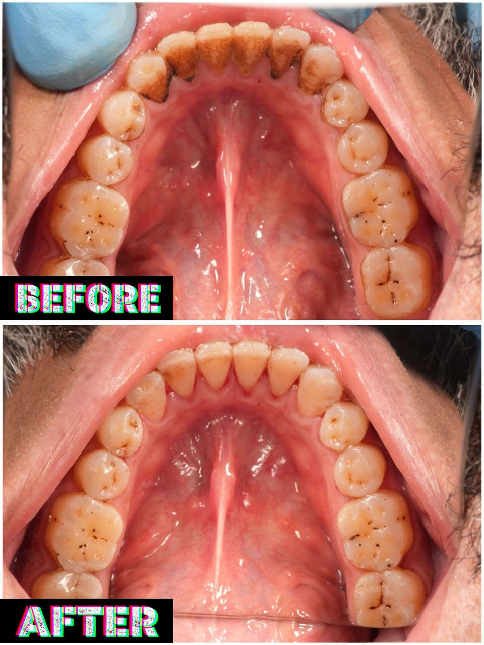 🌙✨ عروض آخر أسبوع من رمضان – مجمع السيف الطبي لطب الأسنان ✨🌙

قبل العيد… اعتنِ بابتسامتك واستفد من عروضنا الخاصة:

🦷 خصومات على حشوات الأسنان  
🦷 خصومات على حشوات الجذور (سحب العصب)  
🦷 خصومات على قلع الأسنان

🎁 عرض خاص: تنظيف أسنان مجاناً مع كل حشوة  
🔎 معاينة مجانية طوال هذا الأسبوع

👨‍⚕️ بإشراف: الدكتور علي سالم جمعة

📍 الموقع: بغداد – الكميرة قرب جامع أبو الزهراء  
🗓 أيام الدوام: السبت – الاثنين – الأربعاء  
📞 للتواصل والاستفسار والحجز: ***********

✨ ابتسامتك تهمنا…
نموذج عن الشغل
