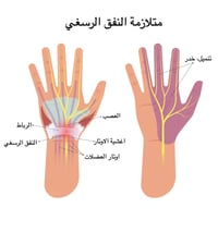 متلازمه النفق الرسغي او carpal tunnel syndrome😞 يحتاج الى تدخل طبي💊 وع...