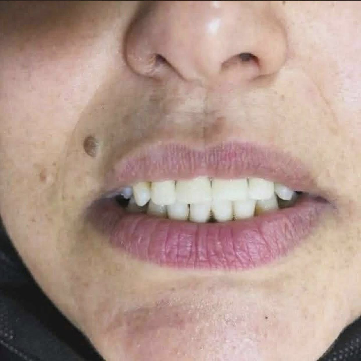 الان في #الخالص
🦷 مختبر التاج الأبيض لصناعة الأسنان👑

نقدّم لكم خدمات مخفضة  في مجال صناعة وتركيب الأسنان بأعلى معايير الدقة والجودة

خدماتنا تشمل:
▫️ تركيبات ثابتة ومتحركة
▫️ أطقم كاملة وجزئية
▫️ زيركون وسيراميك بمظهر طبيعي وجودة عالية

✔ نحرص على تقديم عمل متقن يدوم طويلاً
✔ إمكانية التقسيط الشهري
✔ تخفيضات خاصة لفترة محدودة

📍 الموقع:
سوق الخالص – قرب المستوصف القديم – مقابل صيدلية البتول
(فوق أزياء وكوزمتك الغدير)

📞 للاستفسار والحجز:
***********

📲 تابعونا على إنستغرام:
@whitecrown_dent_

مختبر التاج الأبيض… دقة في العمل، وابتسامة بثقة
