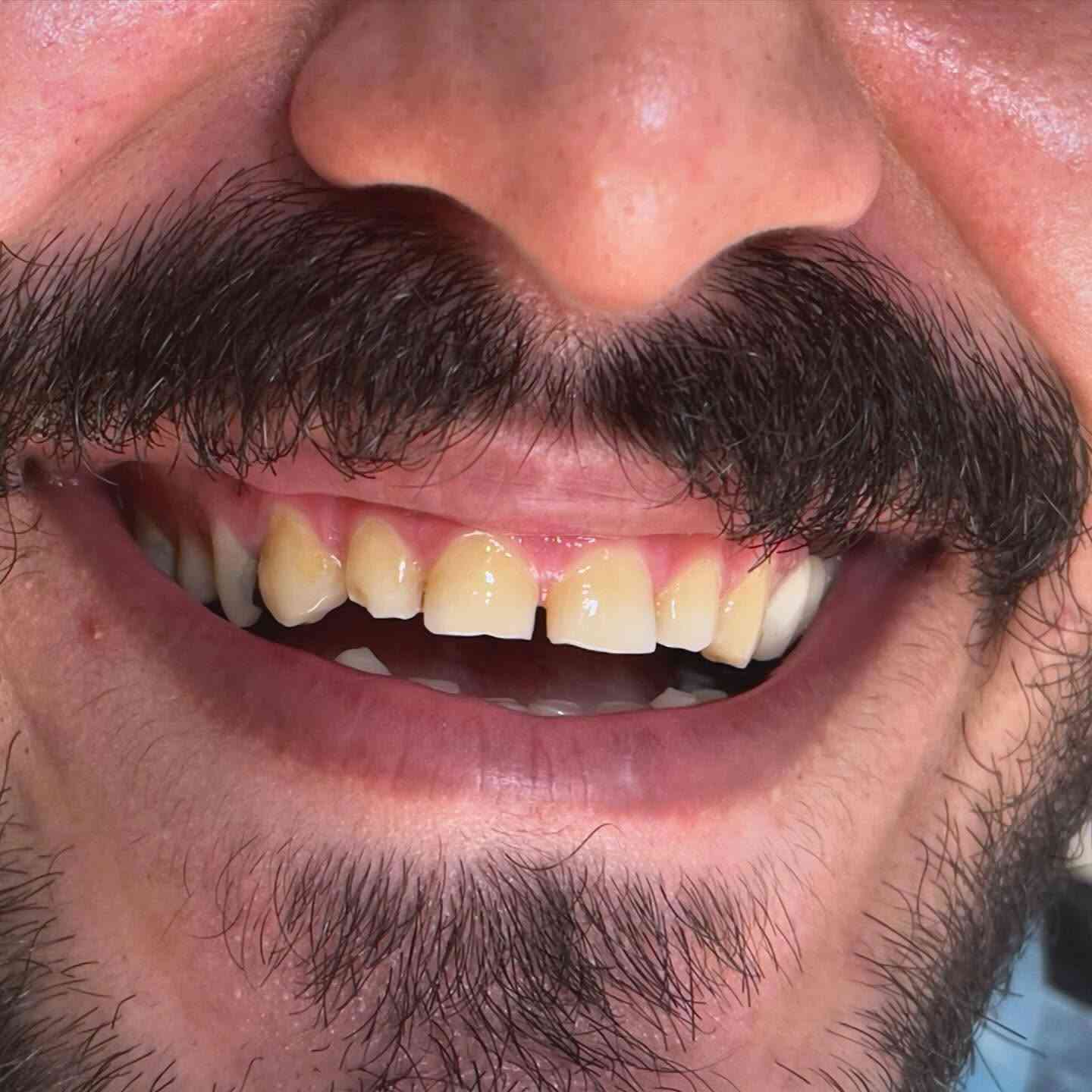 ✨ إذا ابتسامة هوليود كانت حلمكم... اليوم صارت حقيقة. 🤍

شوفوا الفرق قبل وبعد بدون برد للأسنان 😍🦷

ابتسامة طبيعية، مرتبة، وتخلي الثقة ترجع من أول ضحكة.
عيادة دكتورة الدكتورة هند الحسيني 

📍الأمين الثانية – فوق صيدلية غزوان – الطابق الثاني
📞 ***********
@highlight
